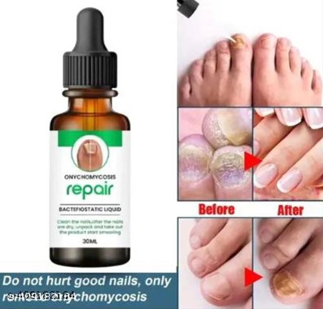 Onychomycosis Nail Serum (30 ml)