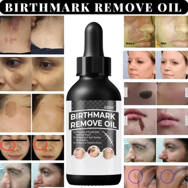 Natural Birth Marks and Blemish Removal Oil (50 g)