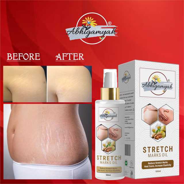 Abhigamyah Present Repair Stretch Marks Removal Natural Heal Pregnancy Breast, Hip, Legs, Mark Oil (100 ml, Pack Of 1) (A-963)
