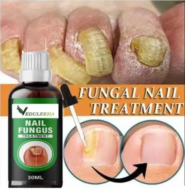 Nail Fungus Treatment Repair Gel (30 ml)