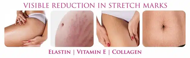 Stretching Stretch Marks Cream (50 g)