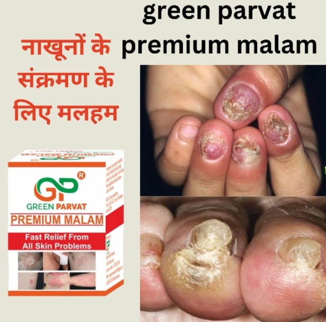 Green Parvat premium malam Anti fungal cream 20 gm