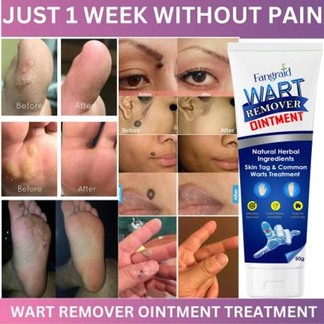 Wart Remover Cream, Massa Removal Cream (100 g, Pack of 1)