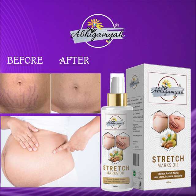 Abhigamyah Present Repair Stretch Marks Removal Natural Heal Pregnancy Breast, Hip, Legs, Mark Oil (100 ml, Pack Of 1) (A-969)