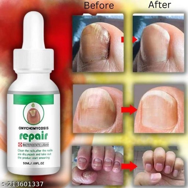 Onychomycosis Nail Serum (30 ml)