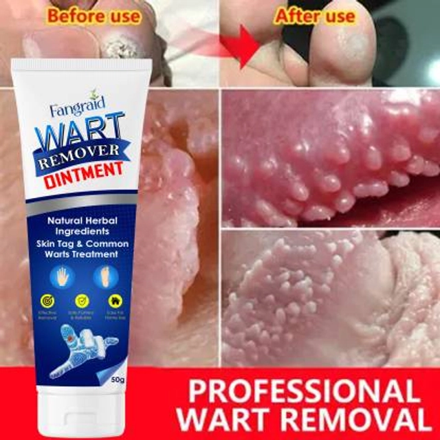 Wart Remover Cream, Massa Removal Cream (100 g, Pack of 1)